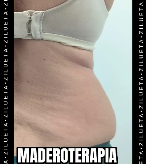 Maderoterapia para la espalda